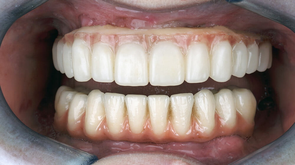 術後臨時假牙