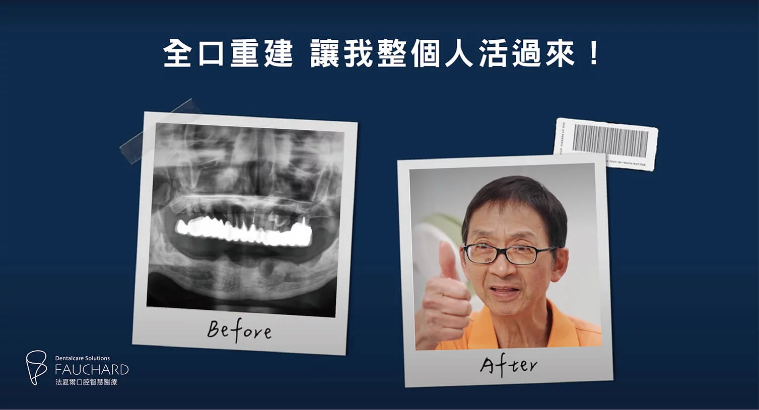 全口重建 Zygoma 案例分享|有牙精神爽!盤先生再次活過來 全口重建心得