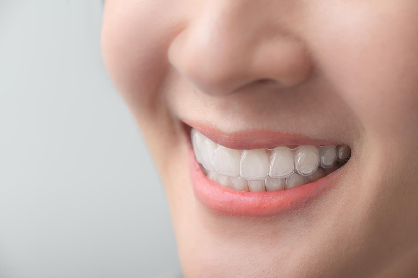 輕矯正適合您嗎?一次搞懂全口隱型矯正 vs. 輕矯正差異! teeth prefect 01