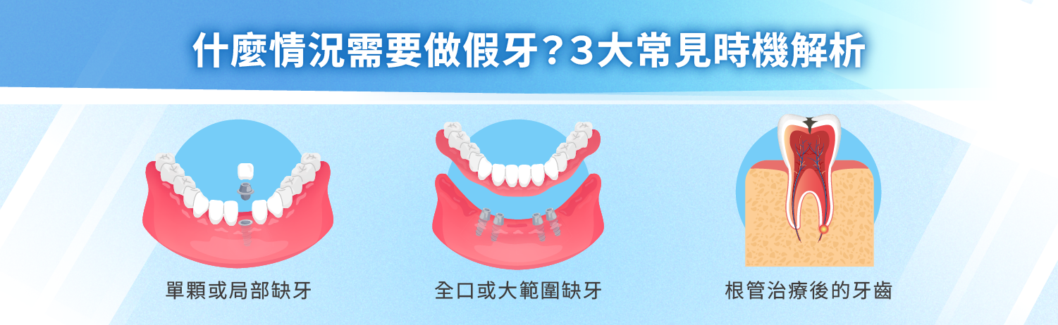 什麼情況需要做假牙？３大常見時機解析